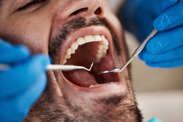Best Emergency Tooth Extraction in Parker, TX